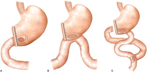 Vagotomy And Antrectomy