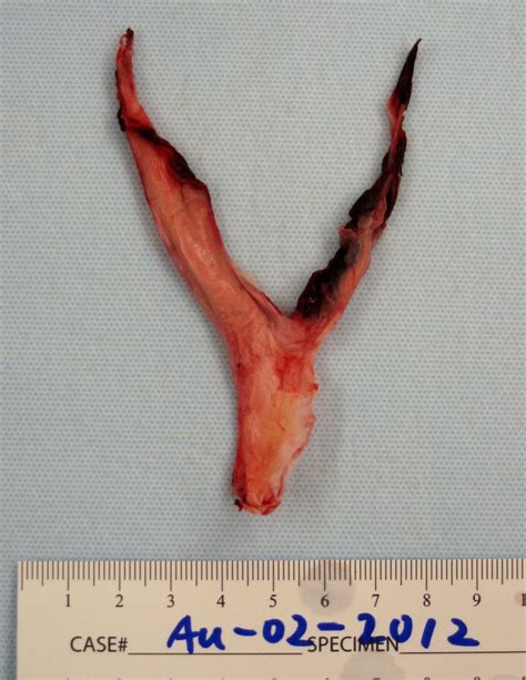 Contemporary Surgical Management of Acute Massive Pulmonary Embolism | IntechOpen