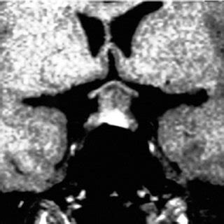 Differential Diagnosis of Lesions of the Pituitary Stalk and ...