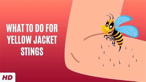 Yellow Jacket Sting Allergy