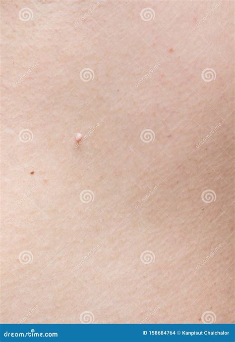 Pedunculated Skin Tag or Acrochondon or Soft Fibroma. Papilloma on Human Skin. Wart Stock Photo ...