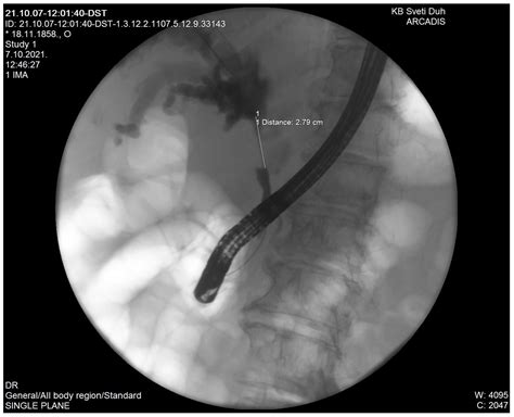 Diagnostics | Free Full-Text | Klatskin-Mimicking Lesions