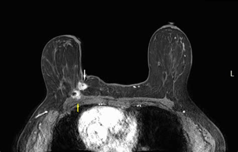 Cureus | Invasive Lobular Cancer Arising in a Surgical Scar From ...