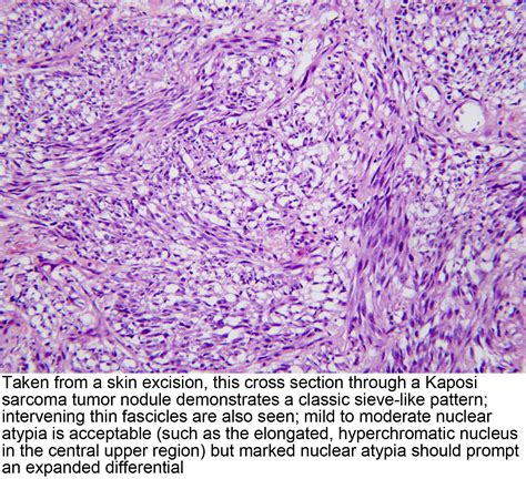 Pathology Outlines - Kaposi sarcoma