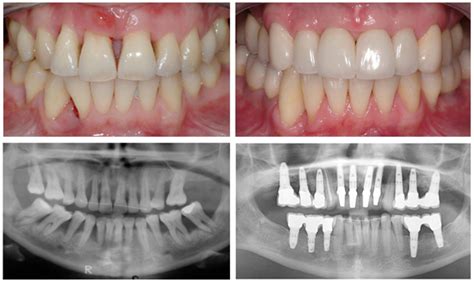 Symptoms Of Bone Loss In Teeth - Teeth Poster