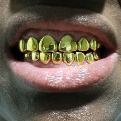 22K Gold (Permanent Crowns)