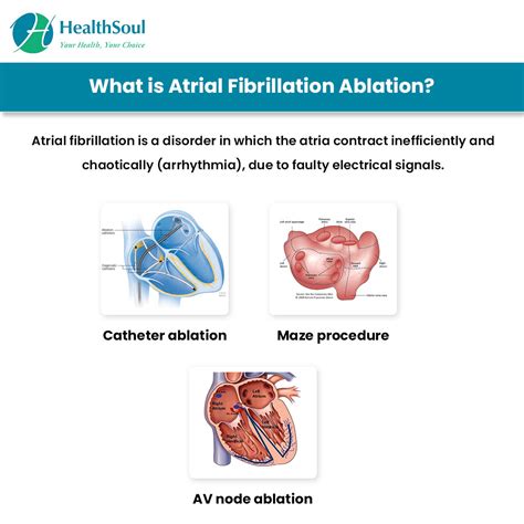 Atrial Fibrillation Ablation: Indications and Complications ...