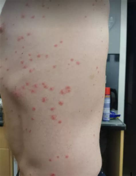 Dad 'eaten alive' by midges after waking up with '500 bites' at Scots ...