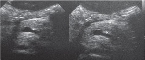 Ultrasound showing swollen pancreas. | Download Scientific Diagram