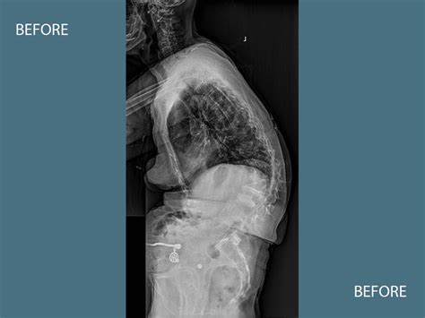 Adult Scoliosis Before & After - Orange, CA