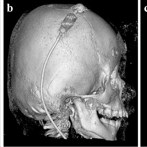 Advantages of CT imaging to evaluate shunt malfunction in a 17-year-old ...