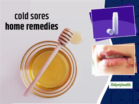 Useful Home Remedies To Get Rid Of Fever Blisters Or Cold Sores | OnlyMyHealth