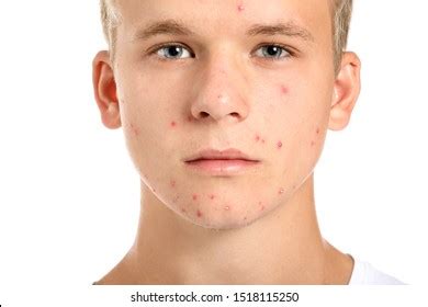 Acne Face: Over 114,193 Royalty-Free Licensable Stock Photos | Shutterstock