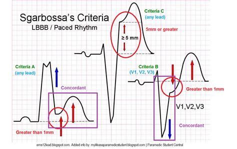 Paramedic Student Central: Sgarbossa’s Criteria