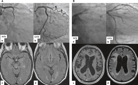 Chronic Microvascular Ischemic Changes - slideshare