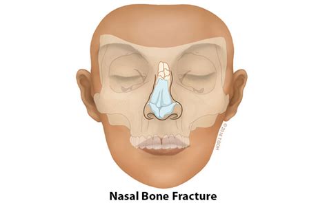 Nasal Bone Fracture Radiology