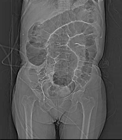 Intestinal ileus or paralytic ileus causes, symptoms, diagnosis & treatment