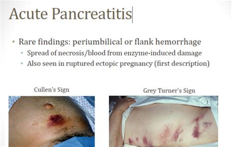 Periumbilical Cullen Sign