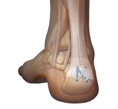 Arthrex - Tendon Fixation for Achilles Insertional Tendinopathy