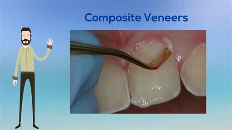 Why Composite Veneers Are Worthwhile Dental Procedures (02) 8090 1105 ...