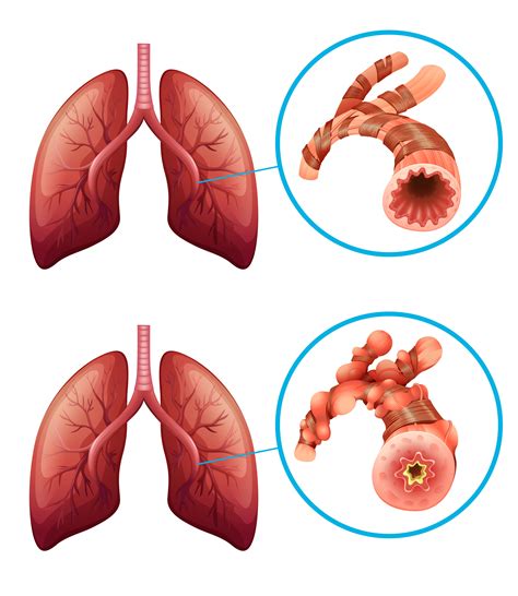 Diagram showing lungs with disease 293456 Vector Art at Vecteezy