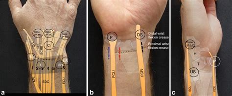 Arthroscopic Wrist Anatomy and Setup | Musculoskeletal Key