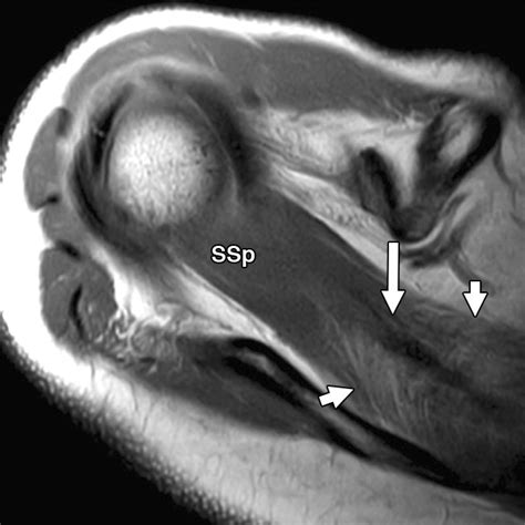 Supraspinatus Muscle Mri