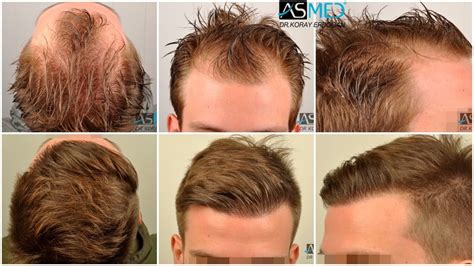 ASMED | Hair Transplant Results Gallery - Norwood 2