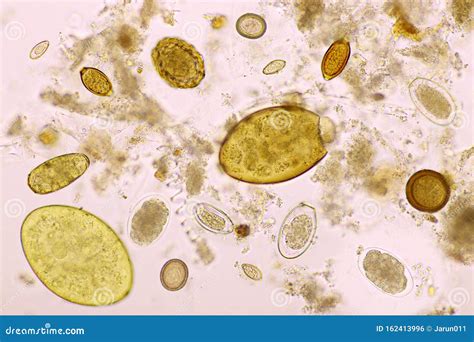 Mix of Helminths or Parasitic Worm in Human Stool Stock Photo - Image of microscopy, fluke ...