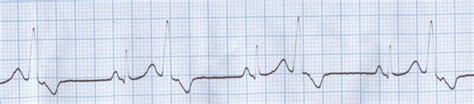 Ventricular bigeminy – All About Cardiovascular System and Disorders