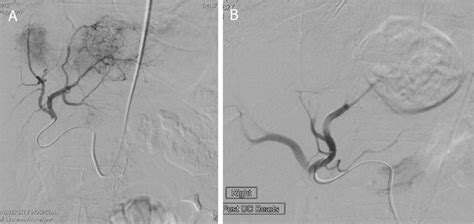 Catheter angiogram before (A) and after (B) transcatheter arterial ...