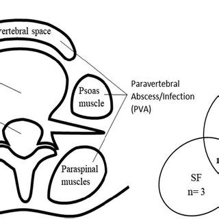 Schematic of the four PSI types and location (left) and Venn diagram ...