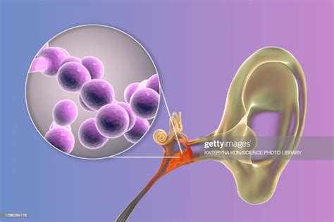 Chronic Fungal Otitis Media Ear Infection Illustration High-Res Vector Graphic - Getty Images