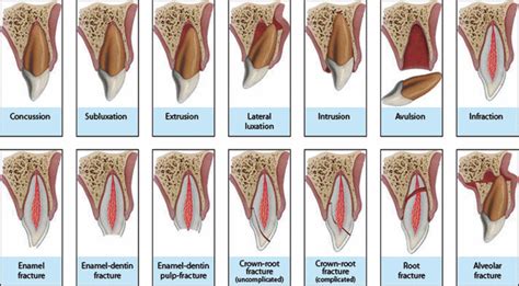 Tooth Concussion