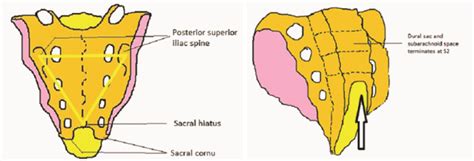 Illustration to identify the sacral hiatus (by Dr. Jaydeep Nandi).