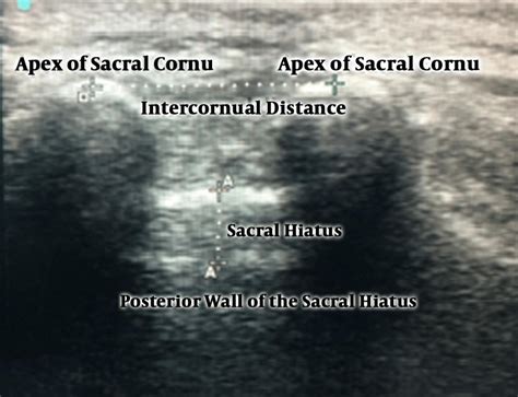 Ultrasound image of the sacral hiatus. The intercornual distance ...