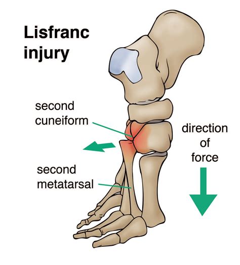 Lisfranc Injuries | An Uncommon Midfoot Injury