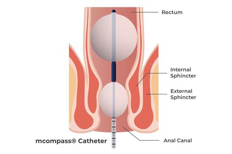 Anorectal manometry | DrLaser Clinic Mumbai | Proctologist | General ...