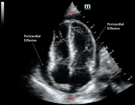 Pericardial Effusion Echo