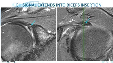 MRI Shoulder SLAP Tears 3 Things to look for - Radedasia