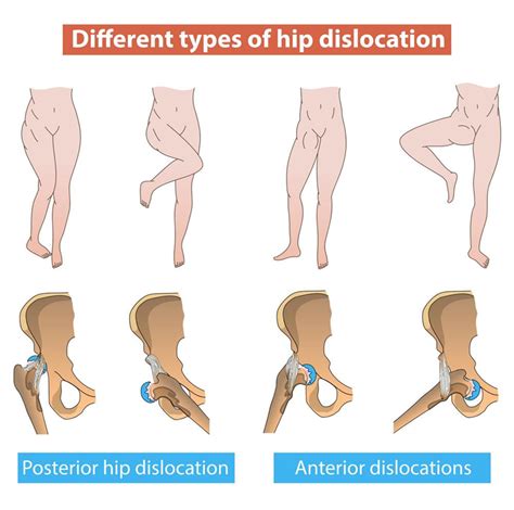 Expert Treatment for Hip Dislocation | Sforzo Dillingham