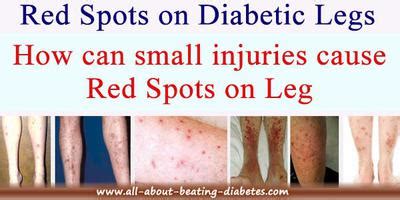 Red spots on Diabetic legs