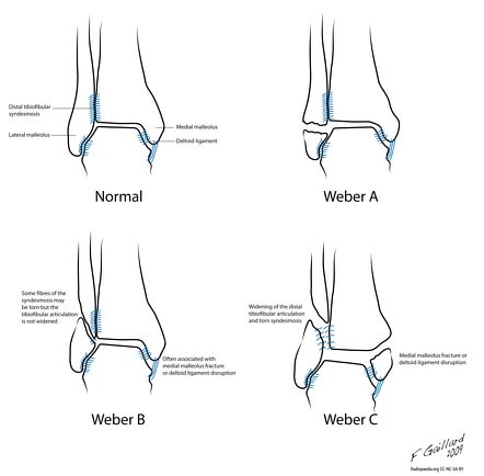 Weber classification of ankle fractures | Radiology Reference Article | Radiopaedia.org