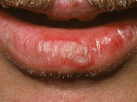 actinic cheilitis lip - pictures, photos