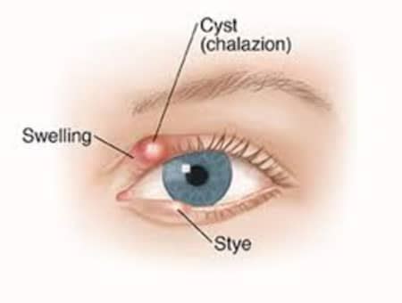 Chalazion – Causes, Symptoms, Treatment – Healthy Food Near Me