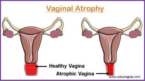 Vaginal Atrophy: Causes, Signs, Management - We Care