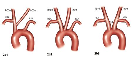 Cureus | Anatomical Variations in Aortic Arch Branching Pattern: A ...