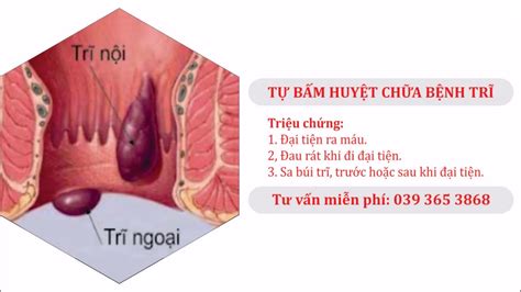 Bấm huyệt chữa bệnh Trĩ Nội Trĩ Ngoại - YouTube