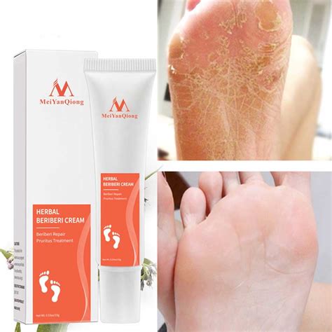 Ligghig 15ml Foot Cream Anti Fungal Infection Fungus Gel Repair Dry ...