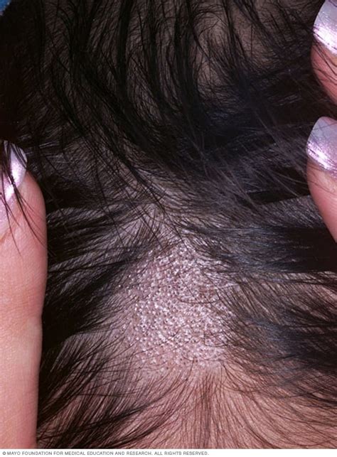 Ringworm (scalp) - Symptoms and causes - Mayo Clinic